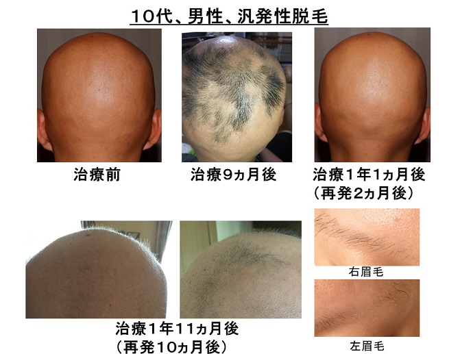 円形脱毛症　病院